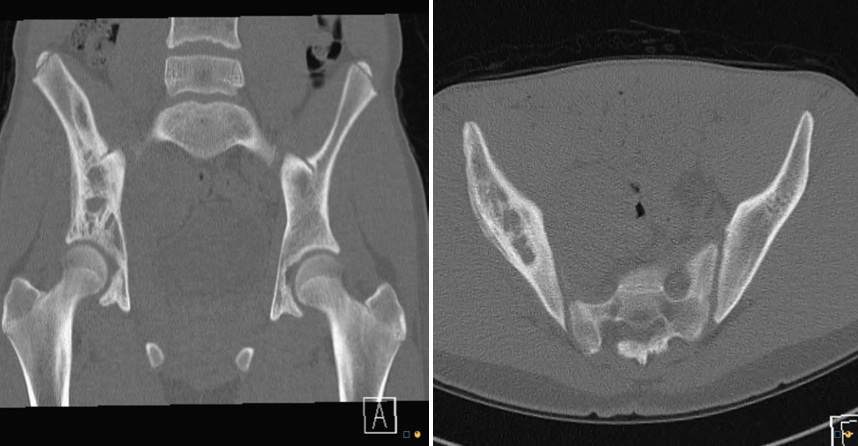 Figure 2 for case Ewing Sarcoma